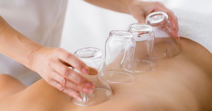 cupping_3_fascial_syndrome_chicago